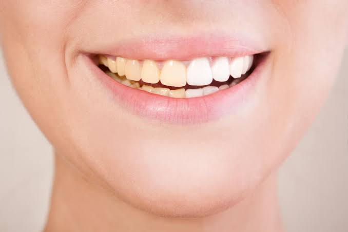 Tips Hilangkan Noda Kuning Pada Gigi