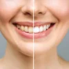 8 Tips Memberisihkan Karang Gigi Mudah Dan Cepat!