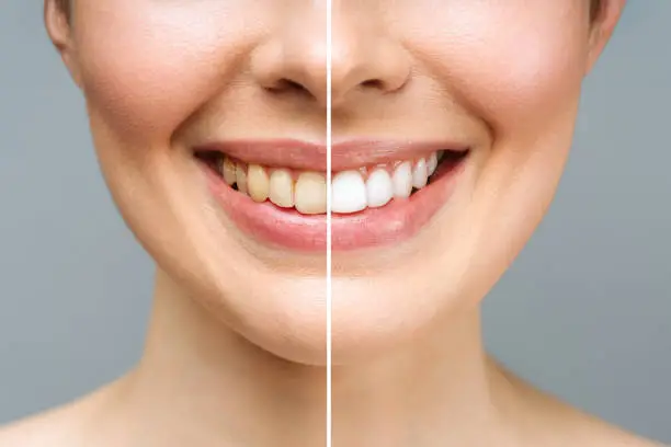 8 Tips Memberisihkan Karang Gigi Mudah Dan Cepat!